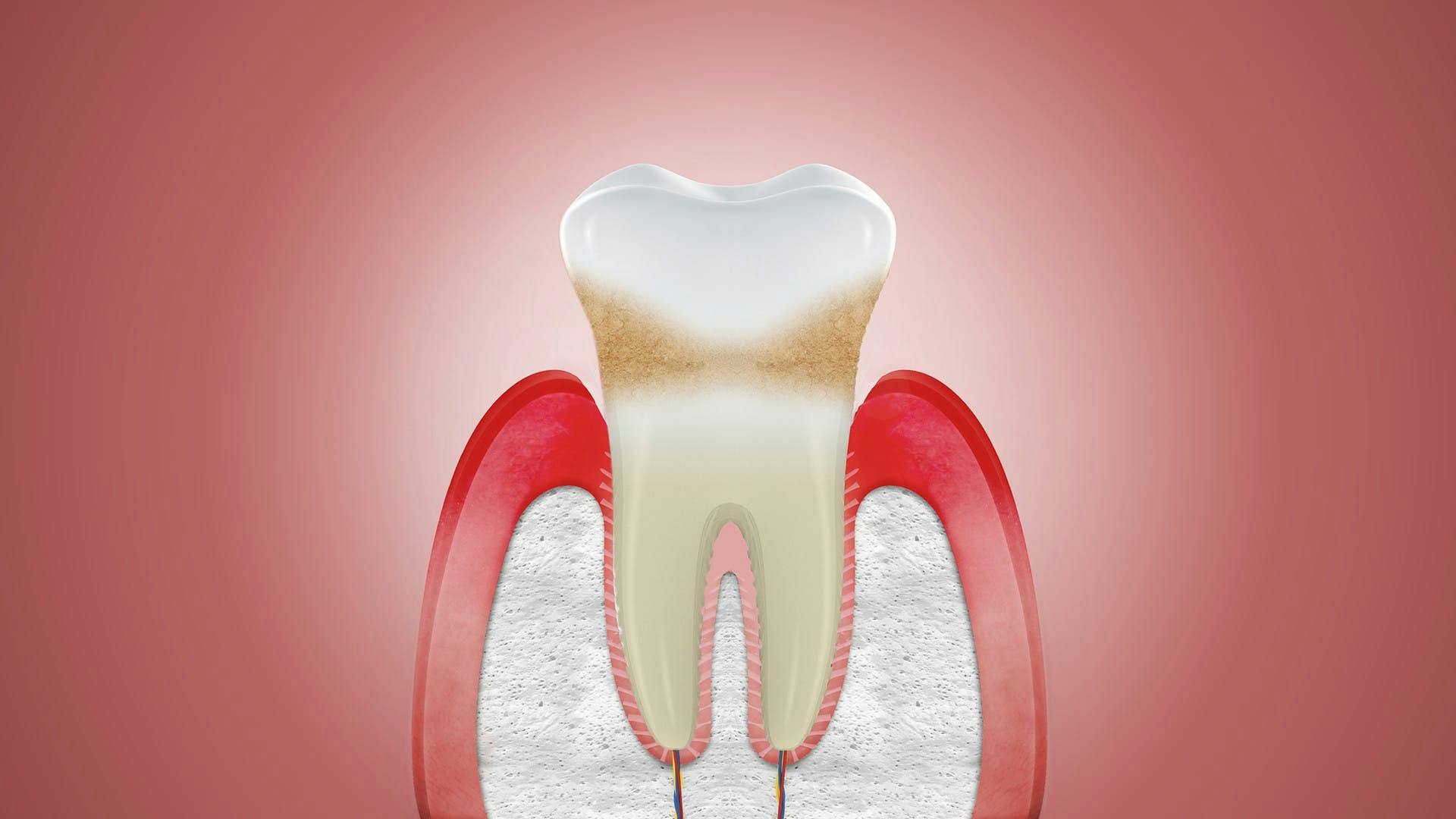 How Long Does It Take Your Gums To Heal After Getting A Tooth Pulled